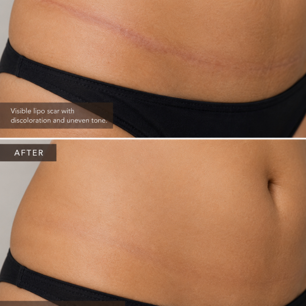 Lipo Scar Camouflage at Restored Hue Paramedical Studio in Atlanta, GA
