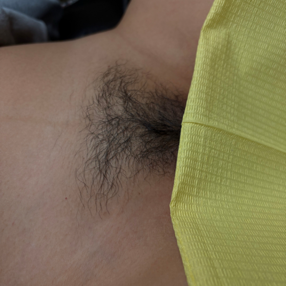 Bikini Line at 5StarEsthetics in Minneapolis, MN