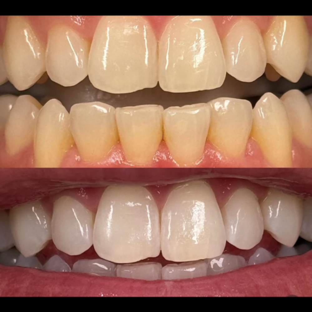 Teeth Whitening Treatment at Icey Whites By Blondee in Lawrence, MA