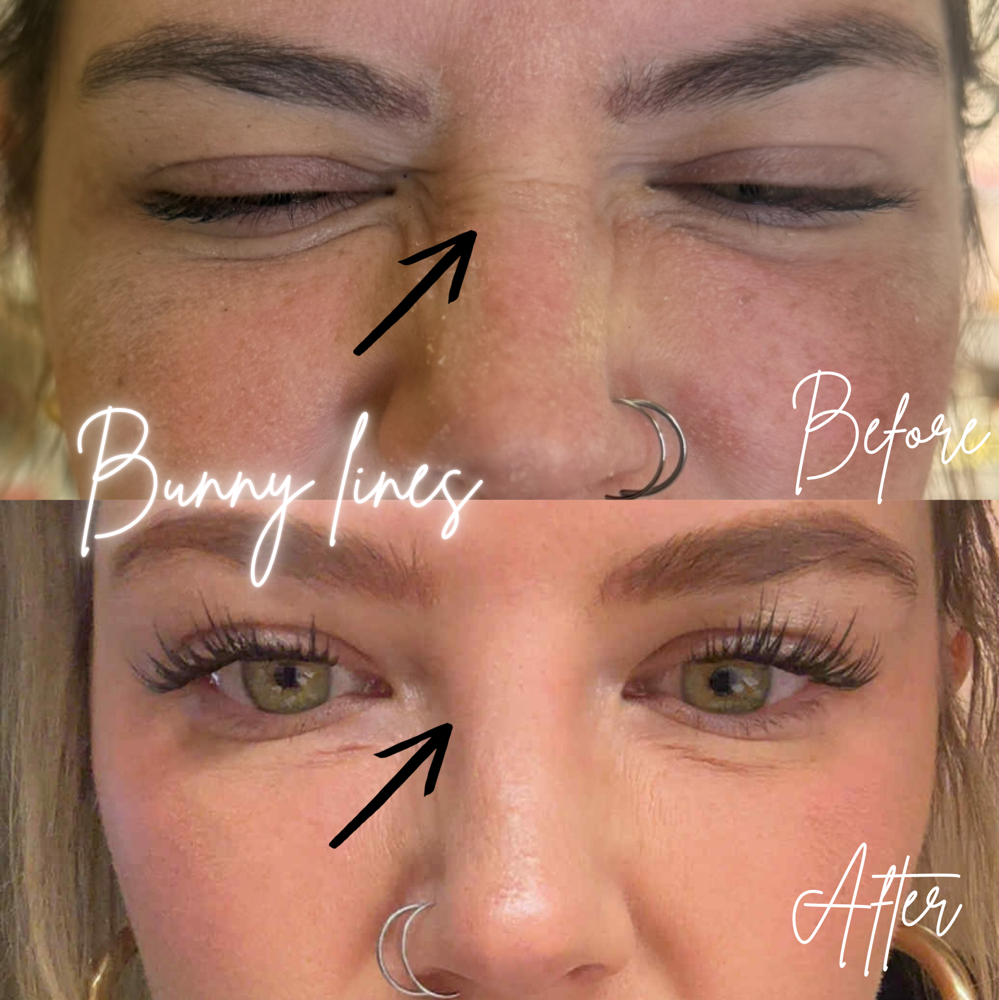 Tox-Bunny Lines💉 at BeautyHolic Aesthetics LLC in Lubbock, TX