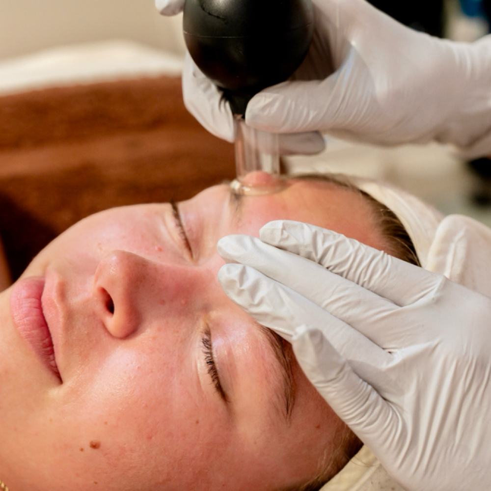 Facial Cupping Add On at SoulSkin Aesthetics in Niles, MI