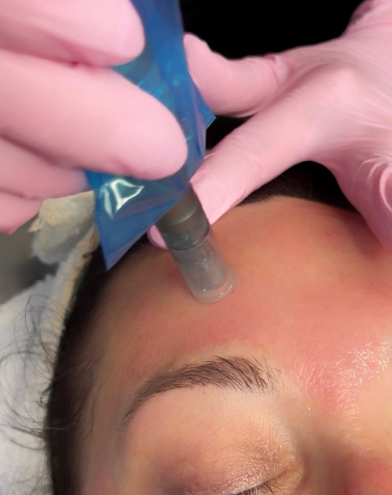3 SESSION PRP AKA VAMPIRE FACIAL