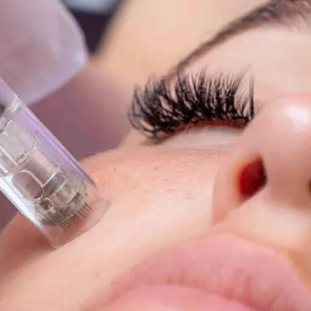 Sweet Skin Microneedling at Sweet Devotion Esthetics LLC in Pueblo, CO