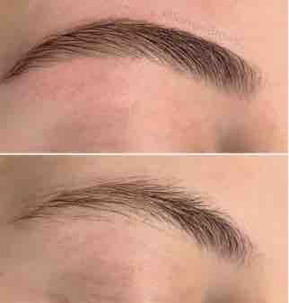 Eyebrow Reshaping