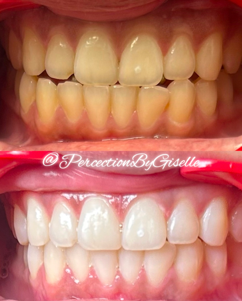 Teeth Whitening 40 Minute Session