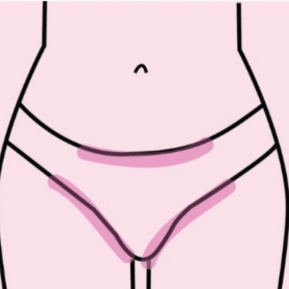 Bikini Line & Upper Legs Package at Facez By Monica in Lakewood, CA