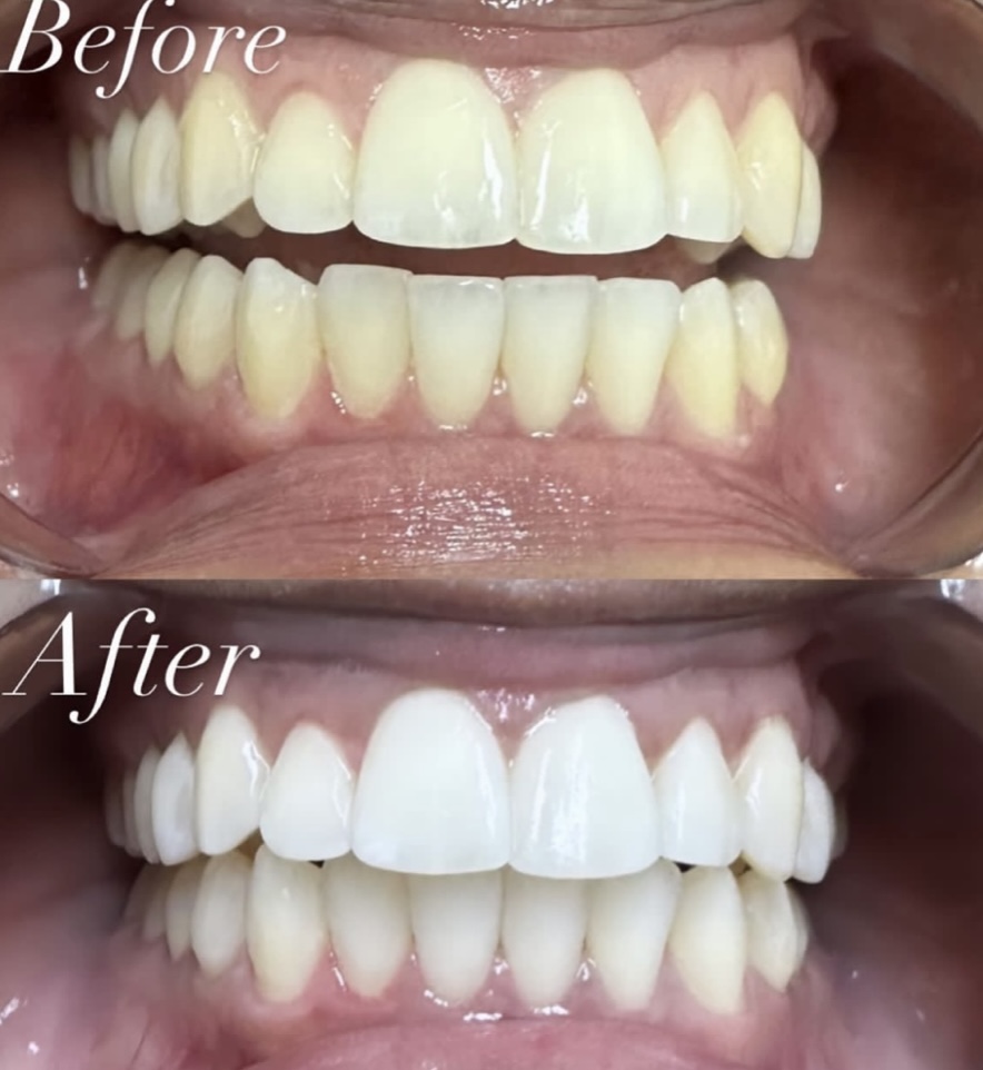 Teeth Whitening