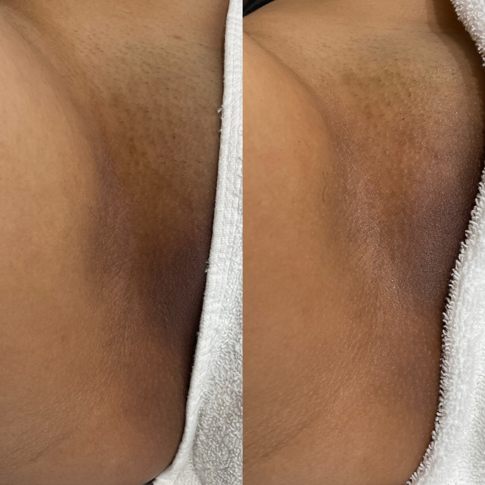 FIRST TIME Brazilian Skin Correctio