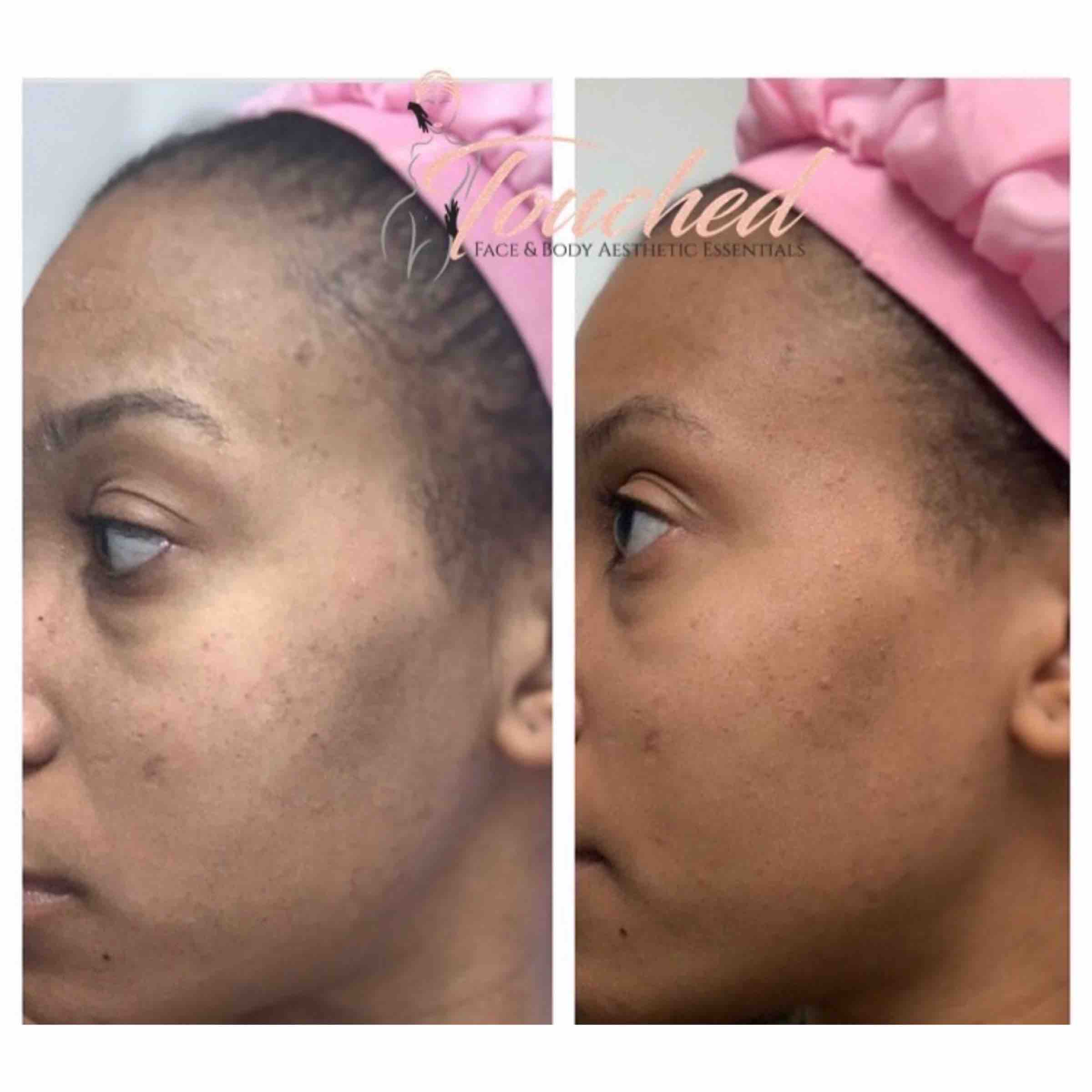 Chemical Peel W/ Post Care Kit