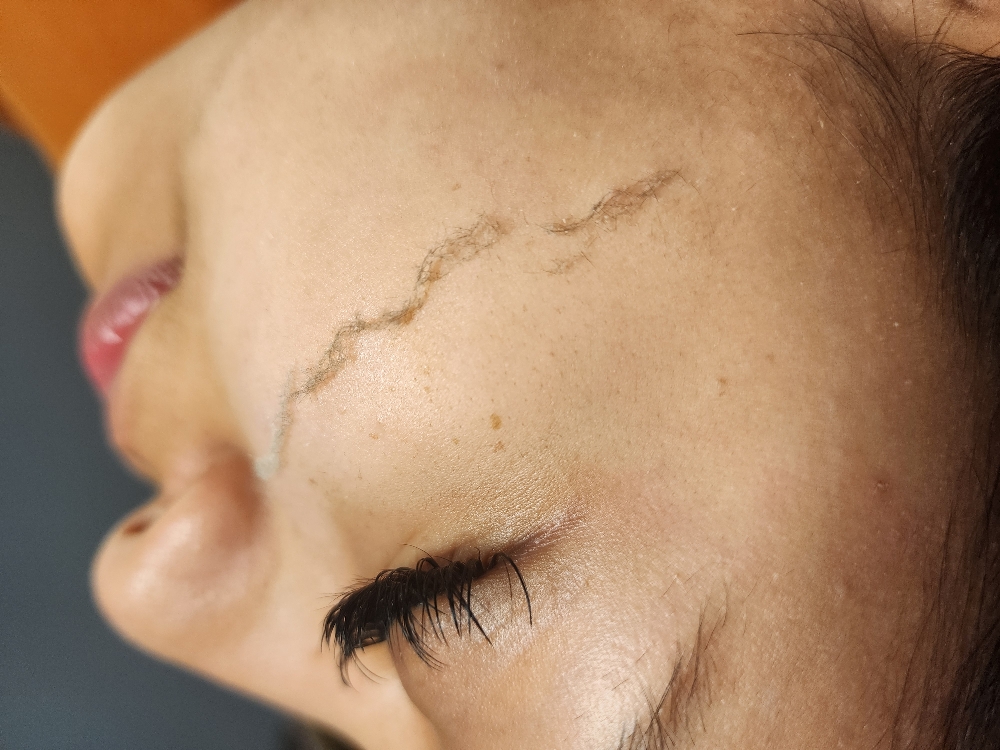 Basic Dermaplane