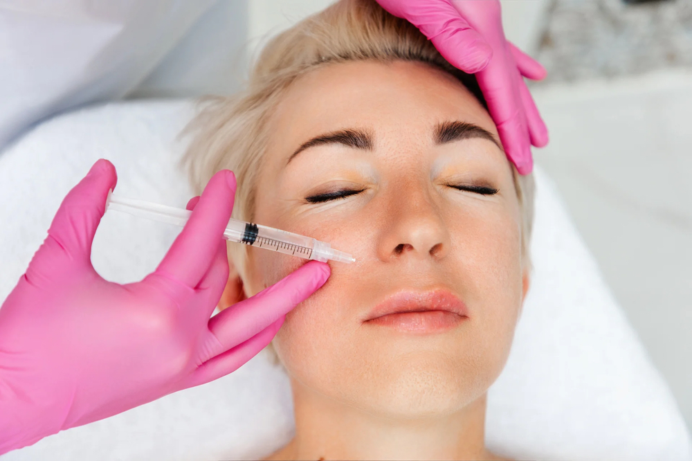 Nasolabial Fold Filler