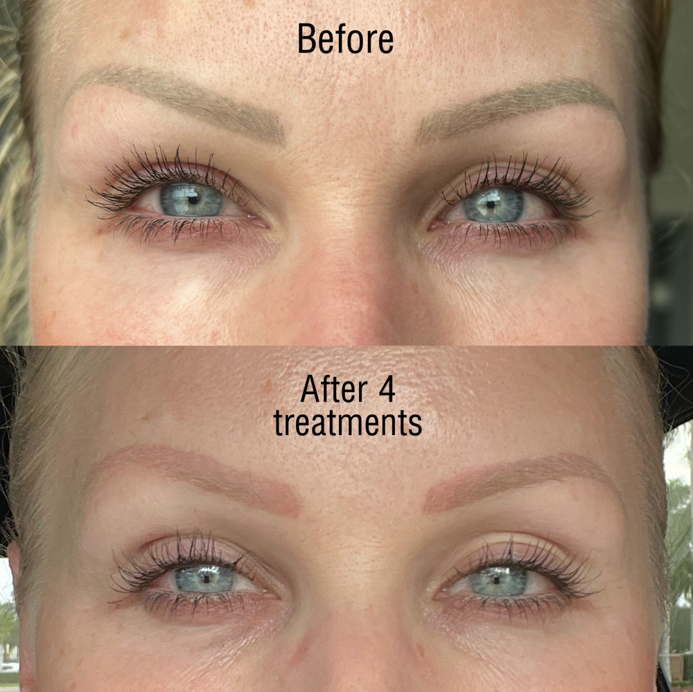 Permanent Makeup Removal