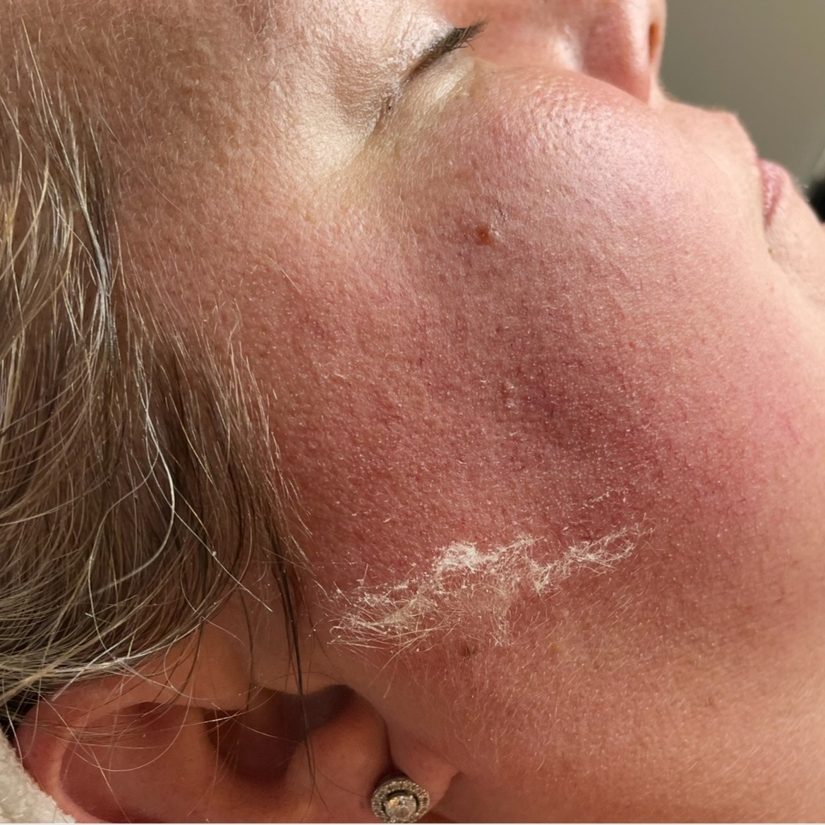 Customized Dermaplane Facial at BB Salon & Spa in Lawrence, KS