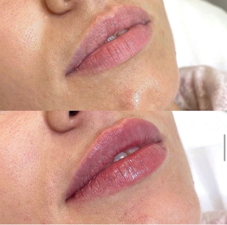 NEEDLE-LESS LIP FILLER 1ML