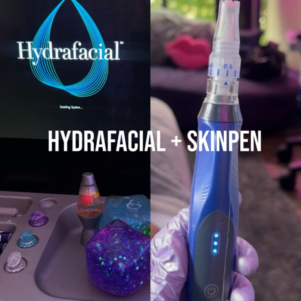 Hydrafacial+SkinPen at Alchemy Skin in Lewisville, TX