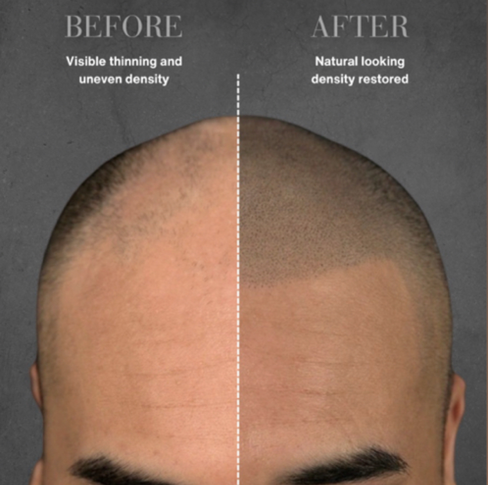 Scalp Micropigmentation at The Bar Aesthetics in Pinole, CA