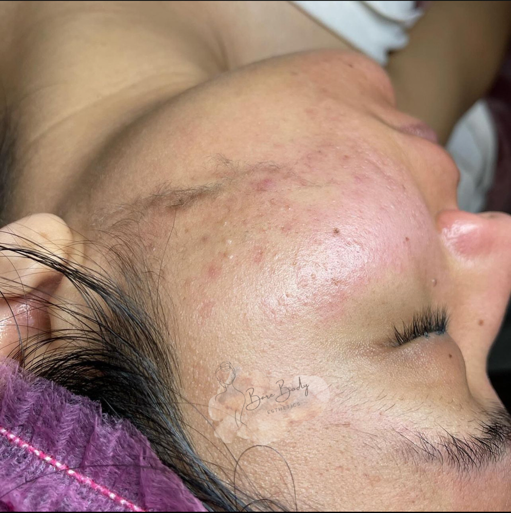 Dermaplane