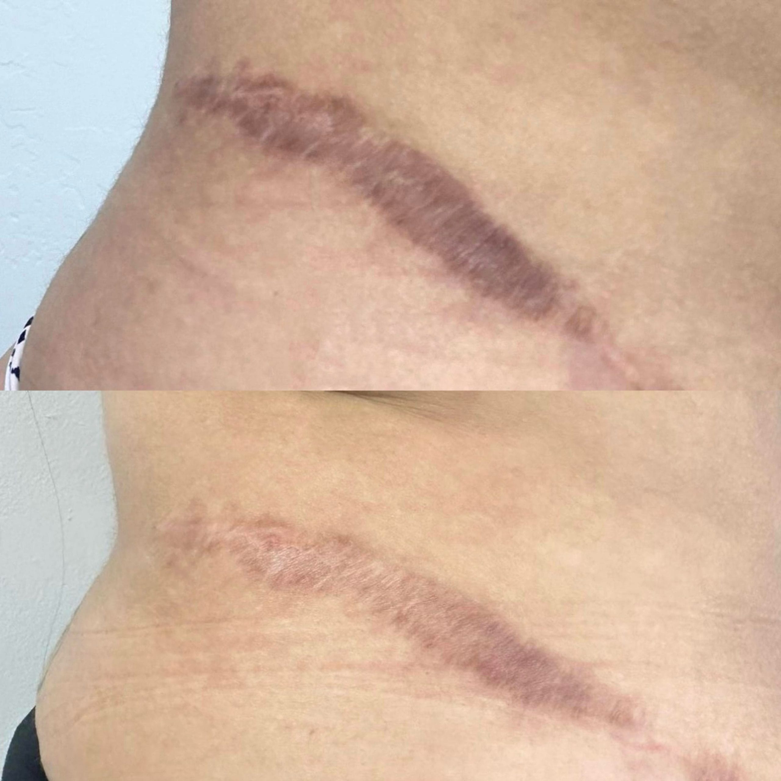 Inkless Scar Texture Revision at Aureum Ink in San Jose, CA
