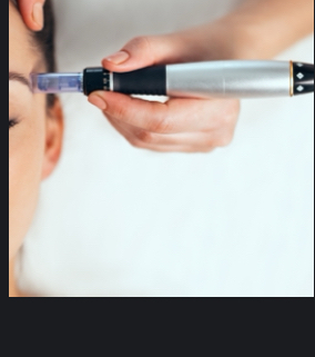 Microneedling at Alabaster Beauty Co in Scottsdale, AZ