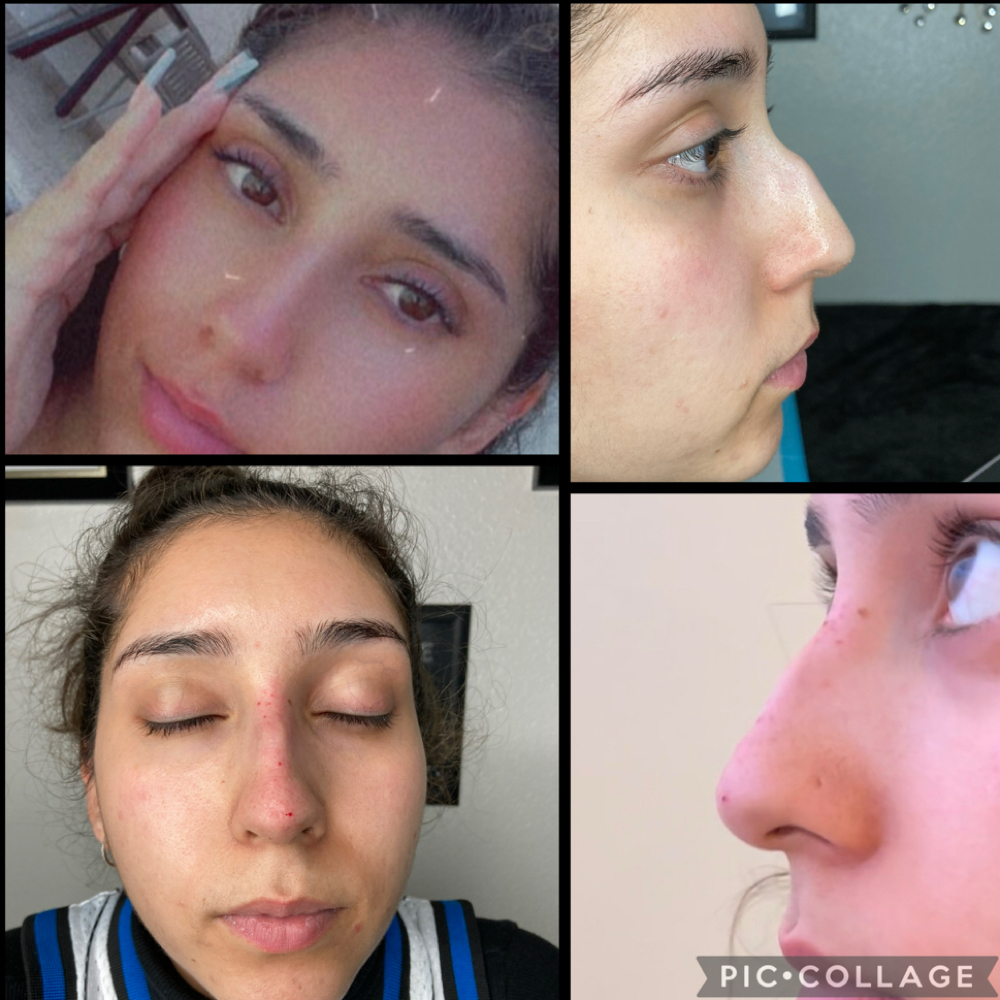 Non-Surgical Nose Job at Glo’s Beauty Creations