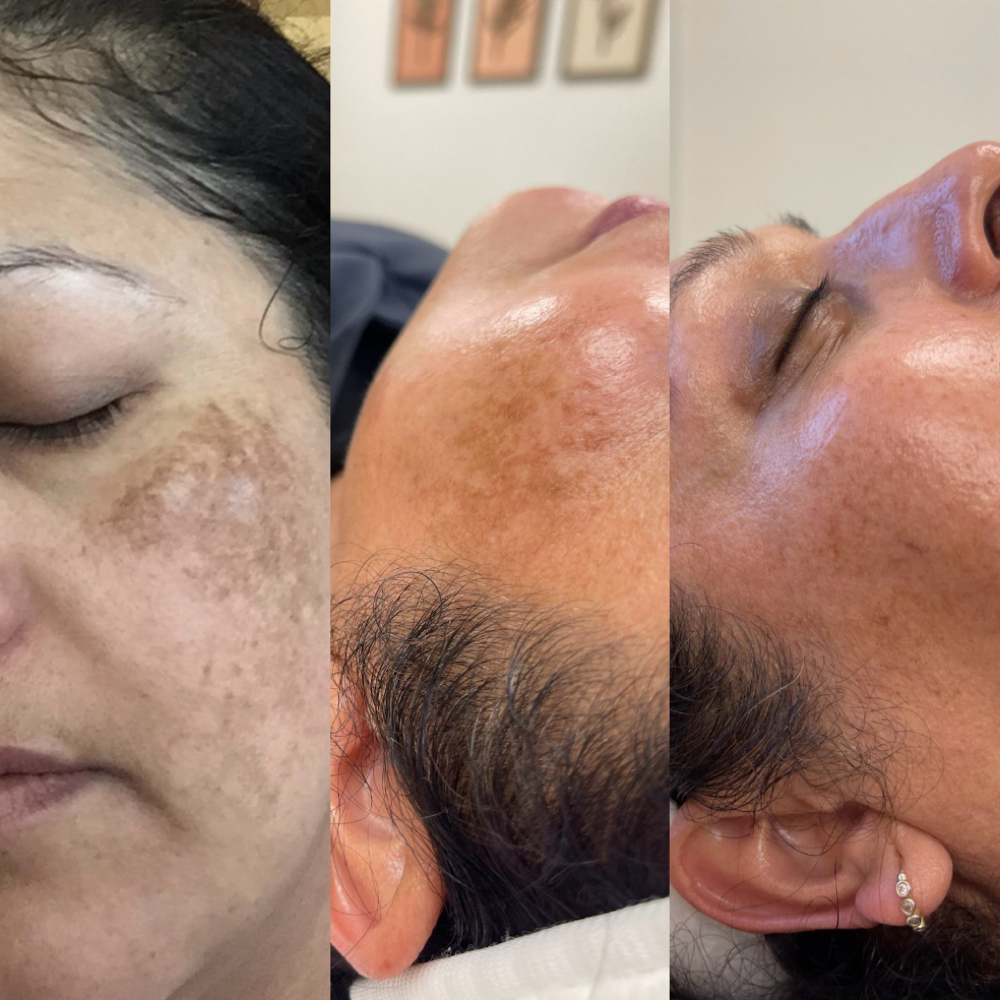 Chemical Peel at Skin and Brows by Carol in Denver, CO