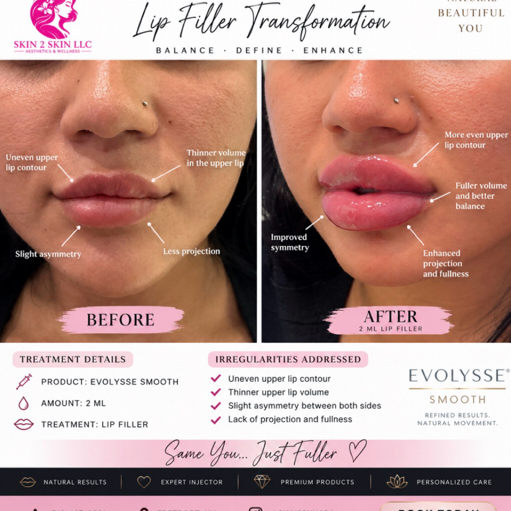 0.5 ML Lip Filler at Skin2skin LLC in Freeport, NY