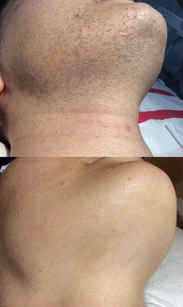 Chin Wax
