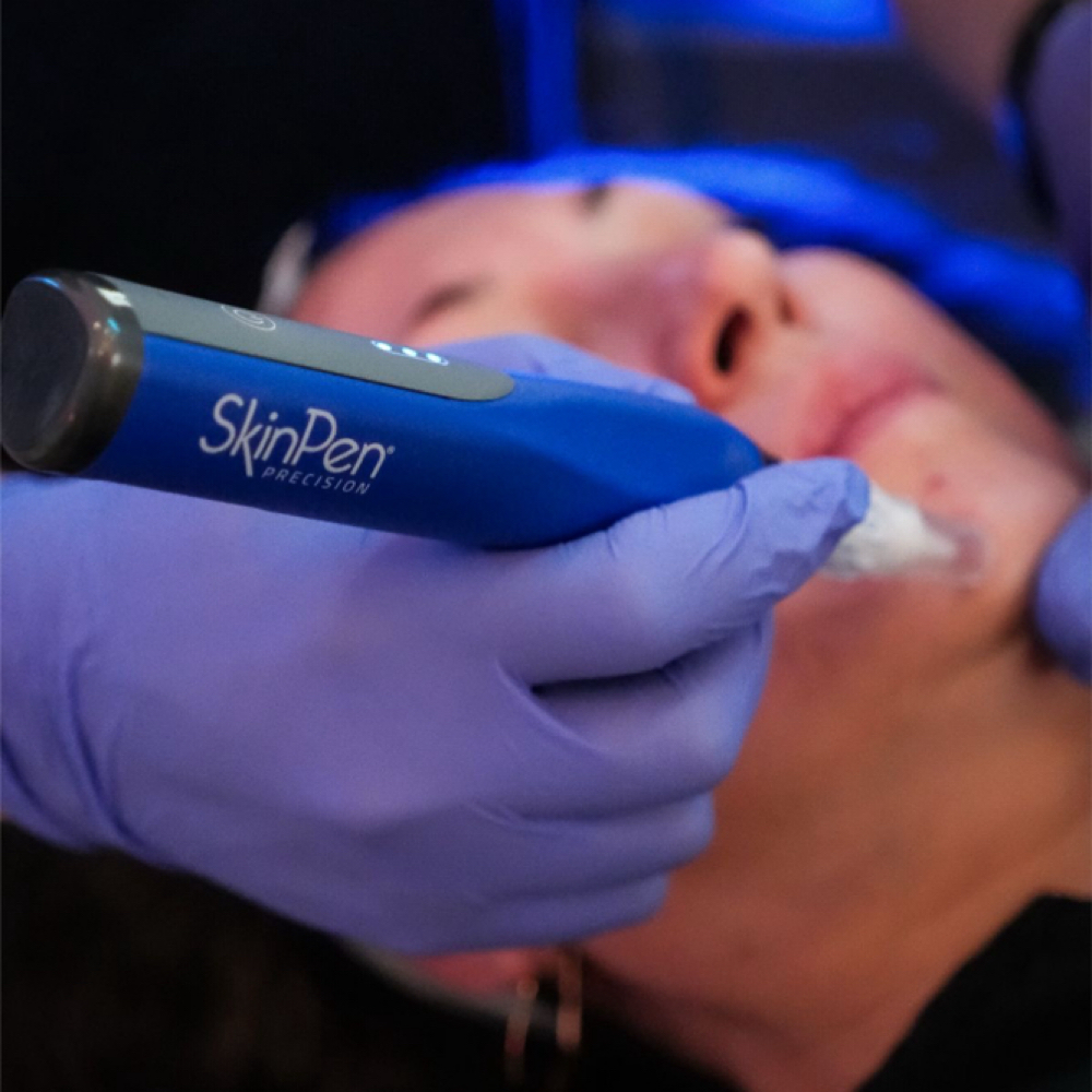 SkinPen Microneedling at NuSkin Beauty Bar in Avondale, AZ
