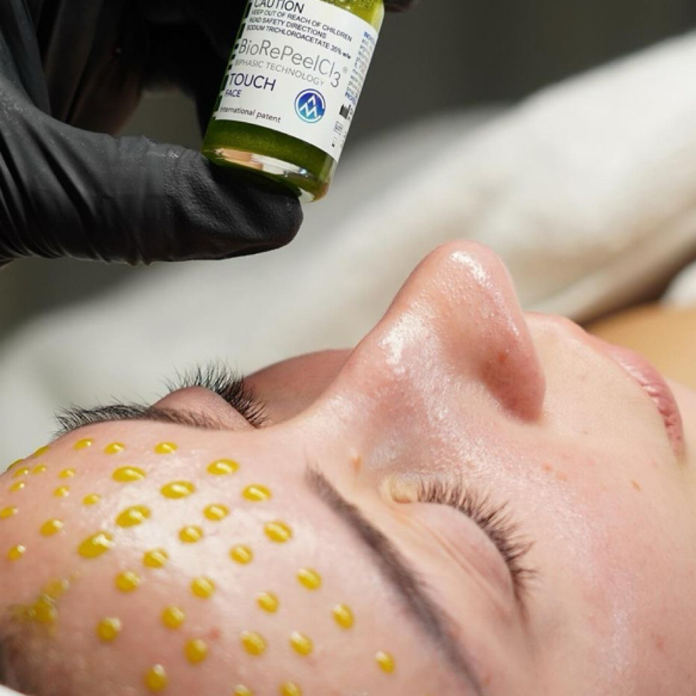 Advanced Microneedling at Skin Reset in New York, NY