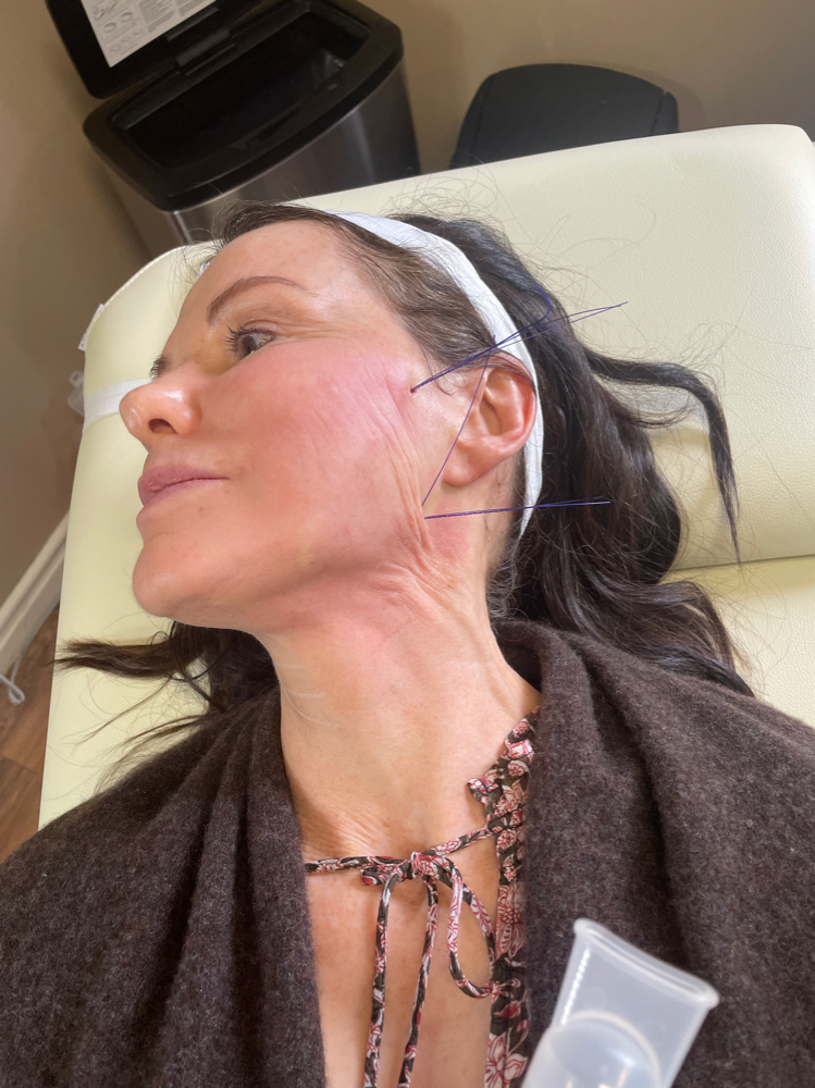PDO Thread Facelift at Aesthetic NP Marie in Portland, OR