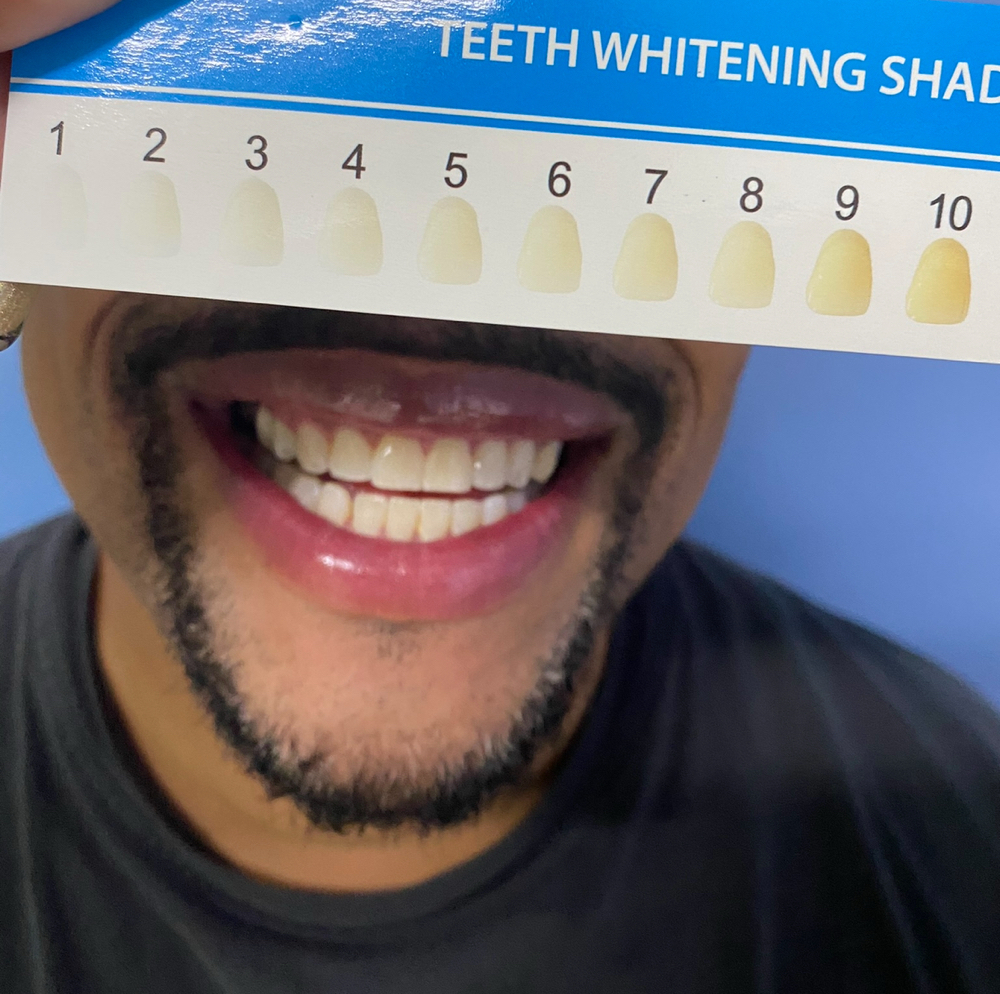 Teeth Whitening