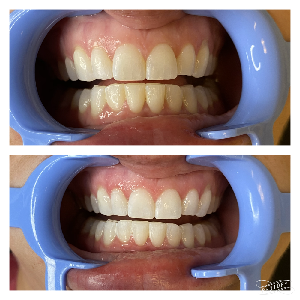 Touch Up Teeth Whitening at Ink Ice & Ivory LLC in Williston, ND