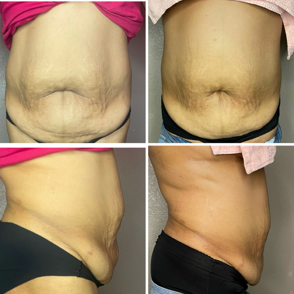 Tighten Me at Sculpted by Lluvia in Weslaco, TX