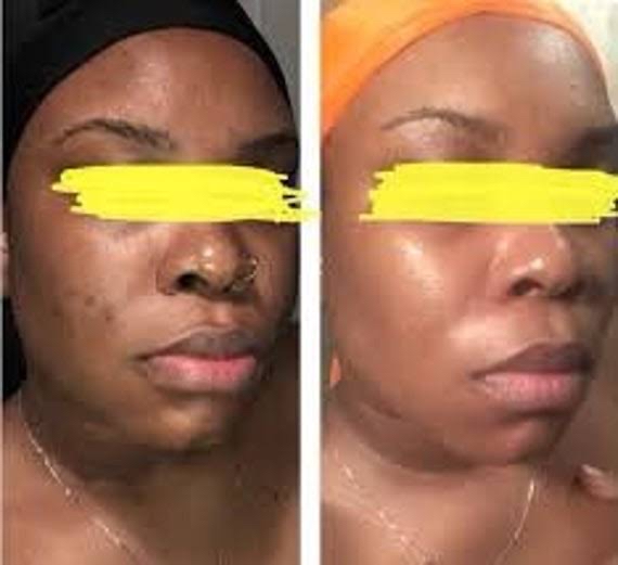 Chemical Peel (existing clients)