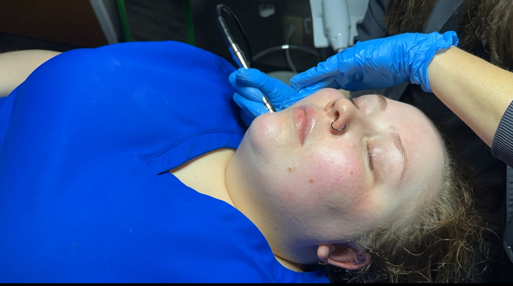 Chemical Peel & Microdermabrasion