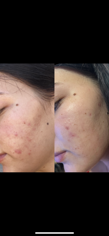 CHEMICAL PEEL