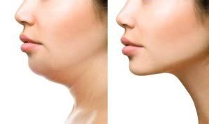 Venus Legacy Face + double Chin(3)