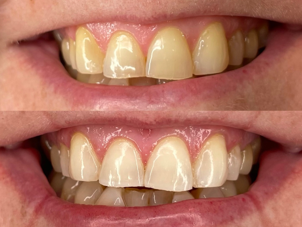 Teeth Whitening