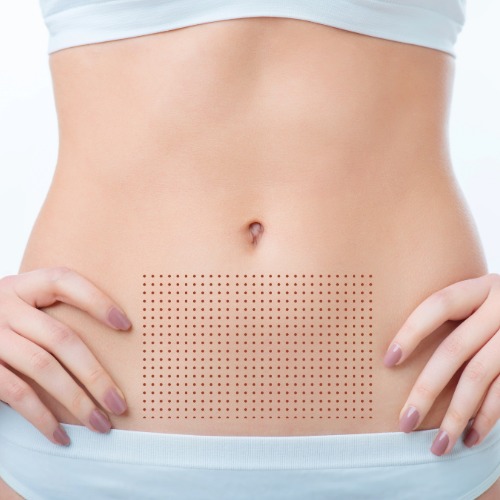 Fat Dissolve | Abdominal Area