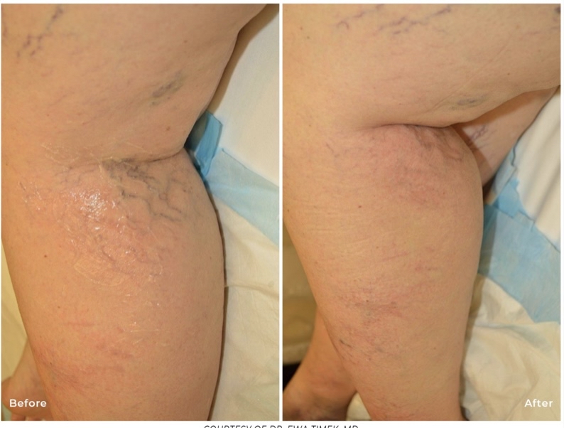 Spider Vein Removal Large Area