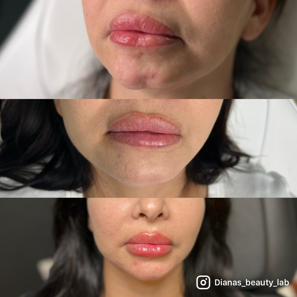 Chin Filler