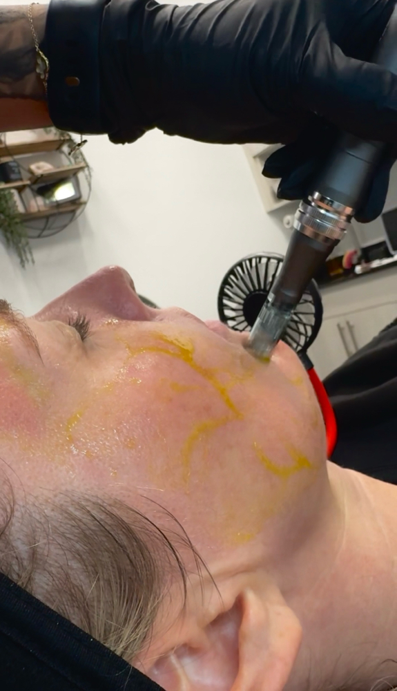 Microneedling X BioRePeel