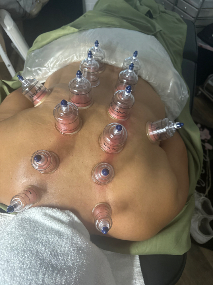 Back Facial With Cupping