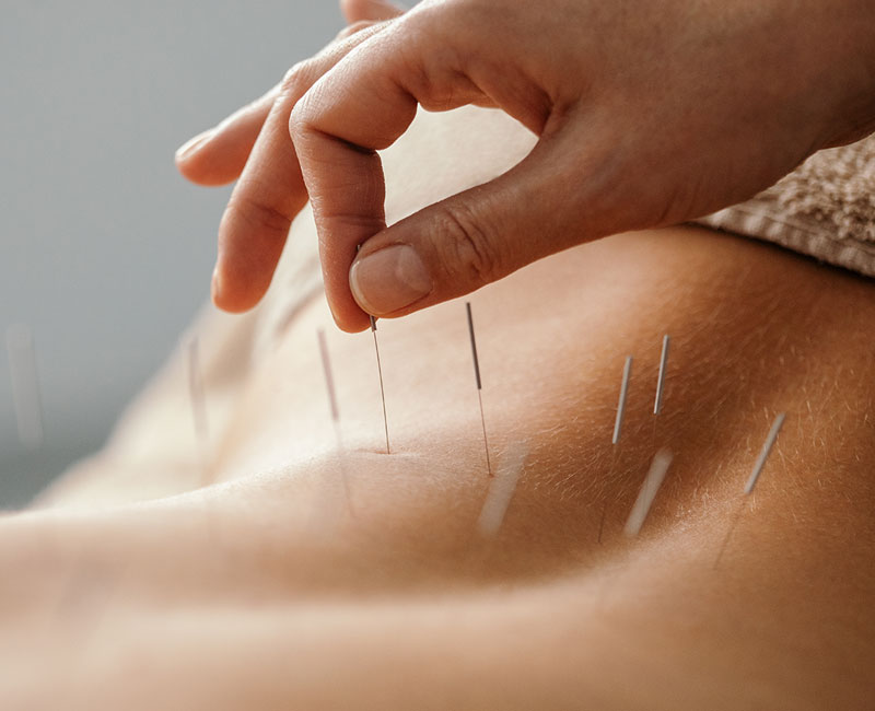 Acupuncture Therapy