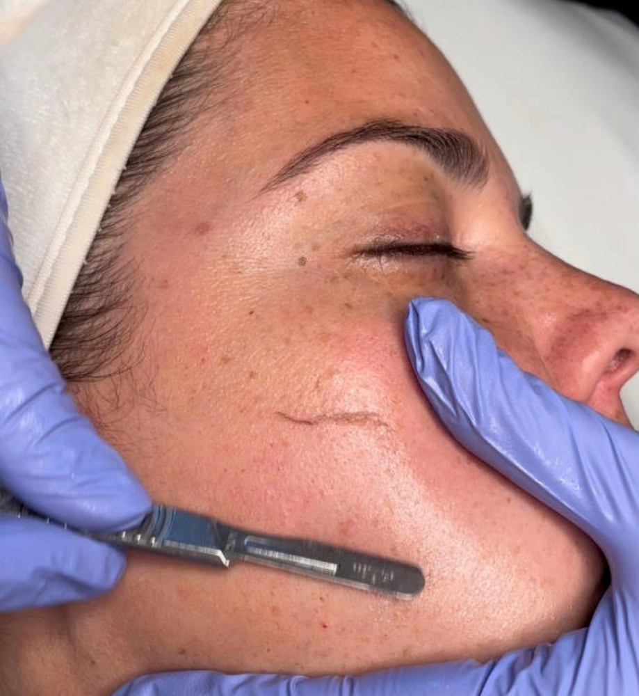 Basic Dermaplane Facial Service