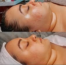 Oxyglow Facial