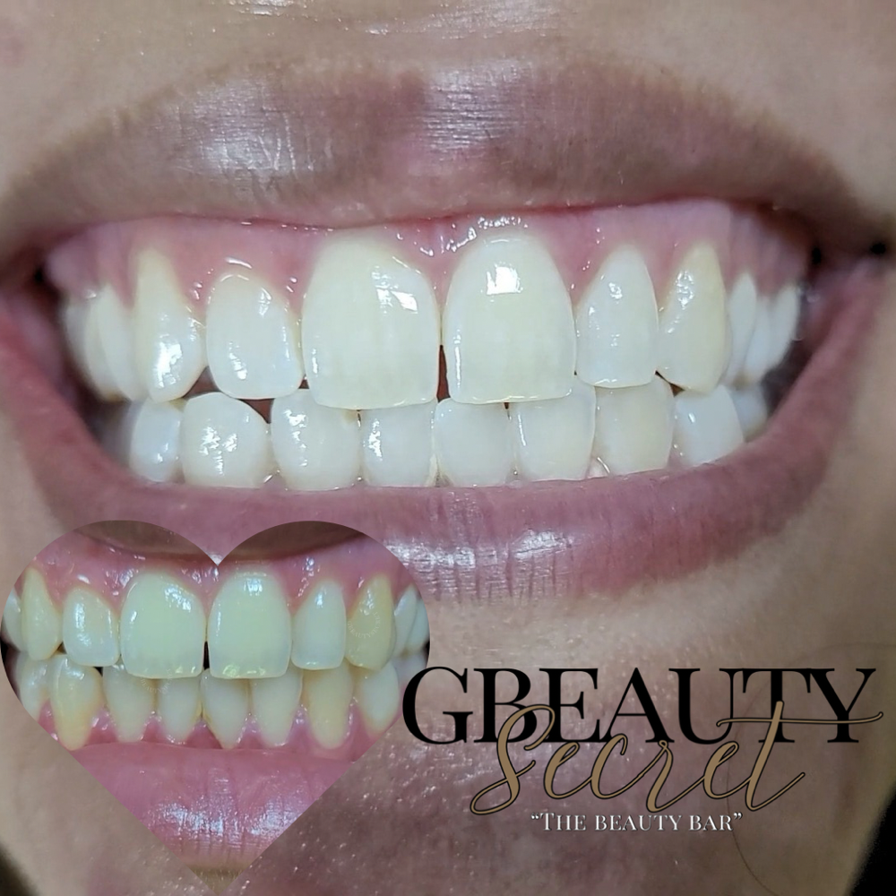 Teeth Whitening: 30 minutes