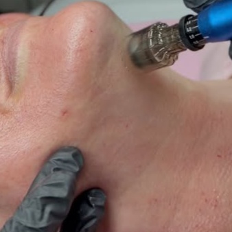 Neck Microneedling Add-On at HP Skin Bar in Durham, NC