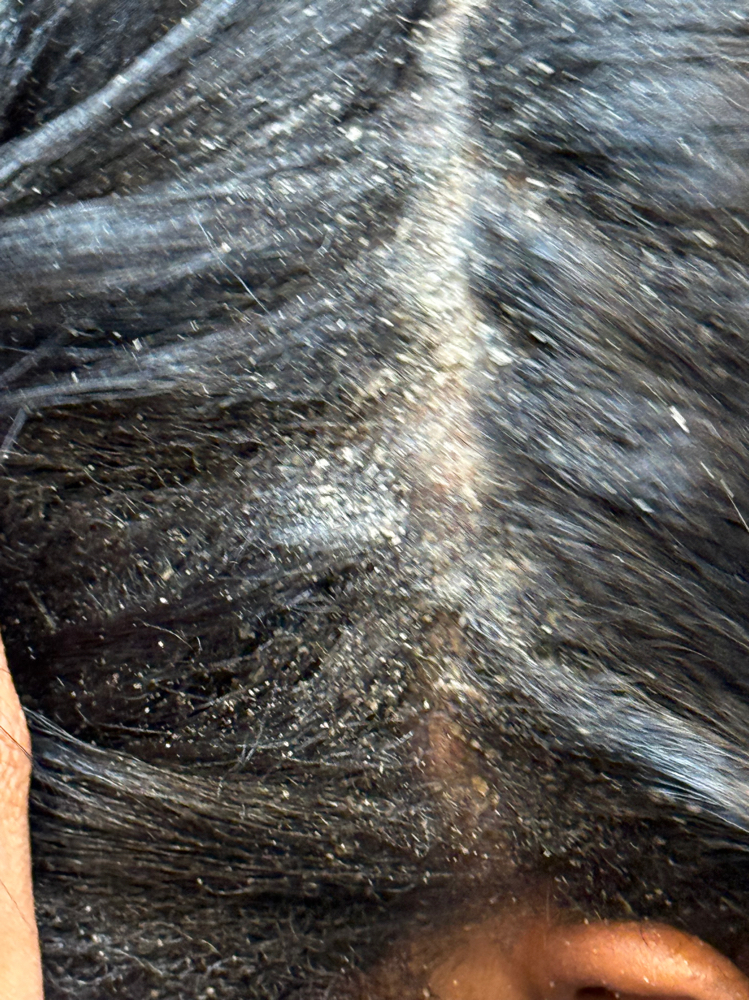 Hair Scalp Exfoliation