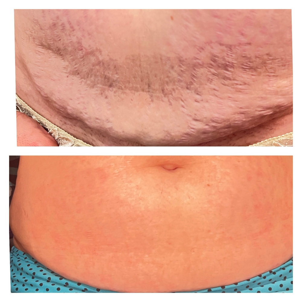 DF & Microcurrent Body Contouring at Tranquil Oasis Spa in Bradenton, FL